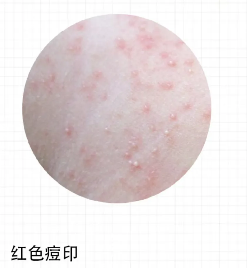 功效精华及药膏选择篇之祛痘印